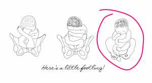 What is a footling breech baby?